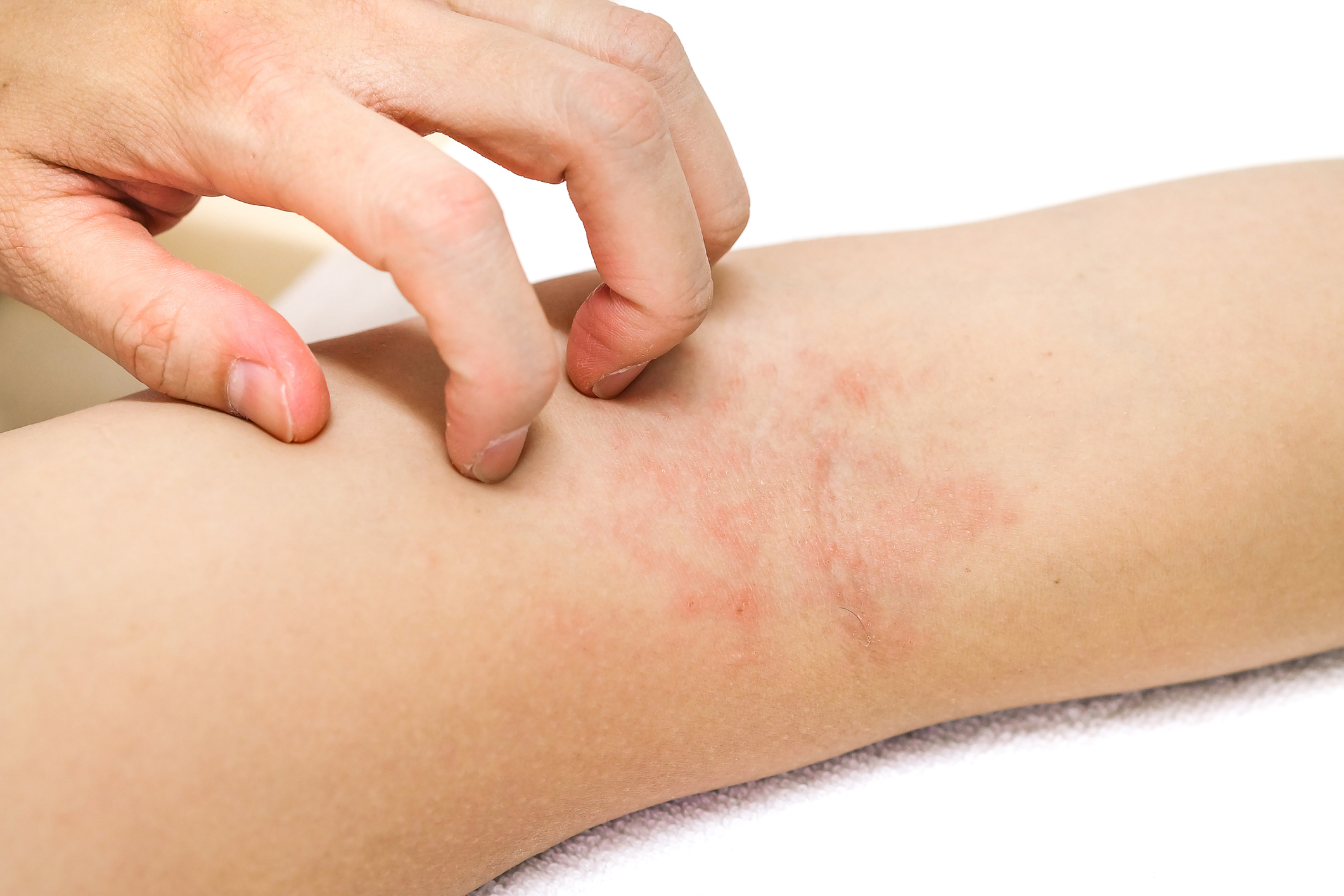 Dermatitis, Rashes, Eczema