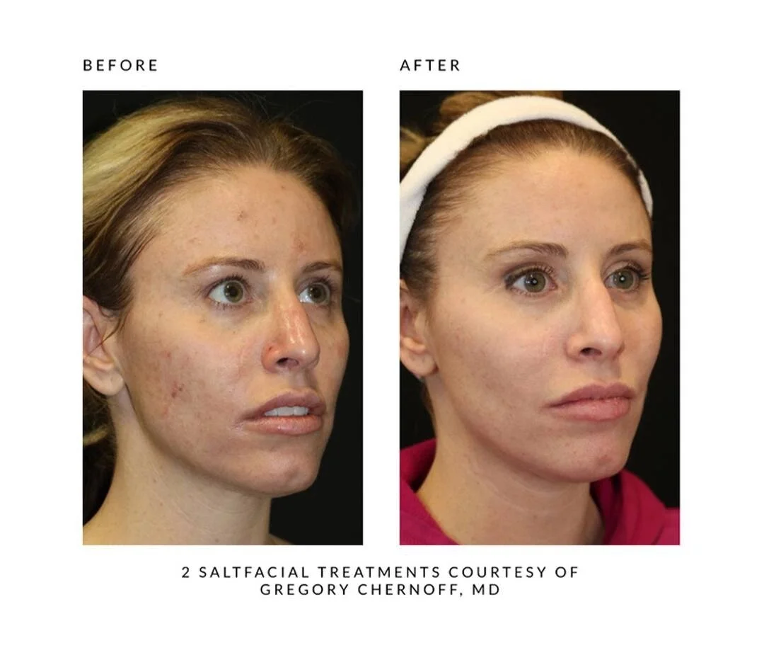 The SaltFacial — Ducharme Dermatology, PC