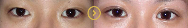 Asian Eyelid Surgery In LA