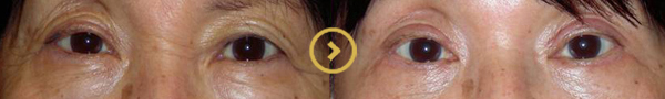 Eyelid Surgery Orange County