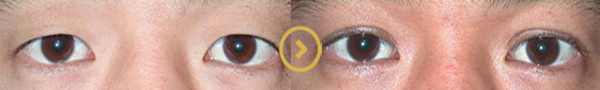 Before and After Blepharoplasty