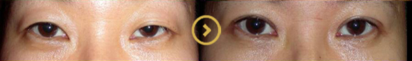 Asian Eyelid Surgery In LA 