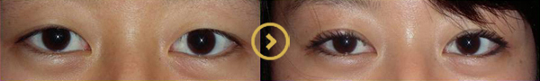 Blepharoplasty – Before and After