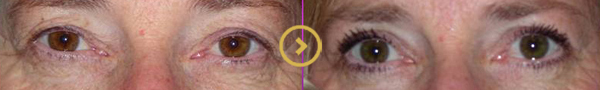 Upper Eyelid Surgery Orange County