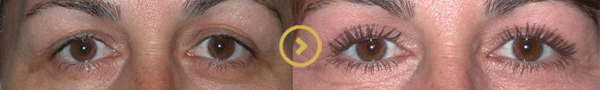 Eyelid Surgery in LA