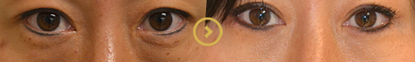 Blepharoplasty in Orange County