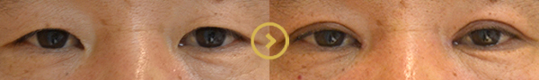 Upper Eyelid Surgery – Before and After