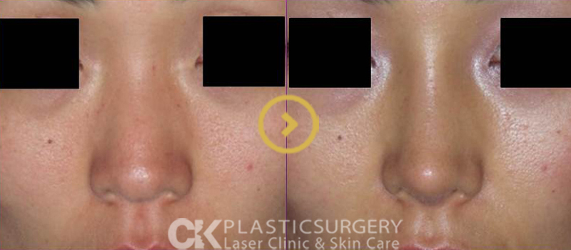 Rhinoplasty Surgery in Orange County