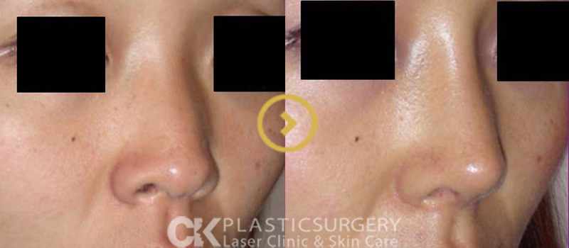 Rhinoplasty Surgery – Before and After