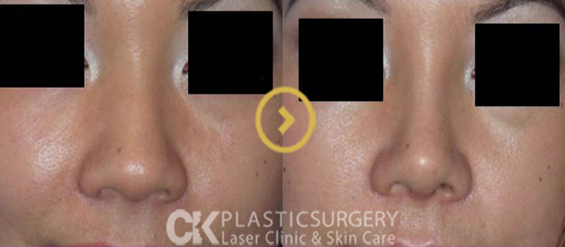 Asian Nose Surgery Orange County