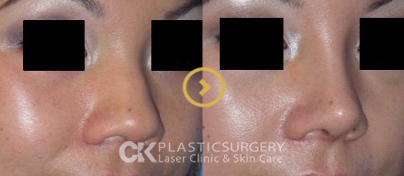 Rhinoplasty Surgery in Orange County