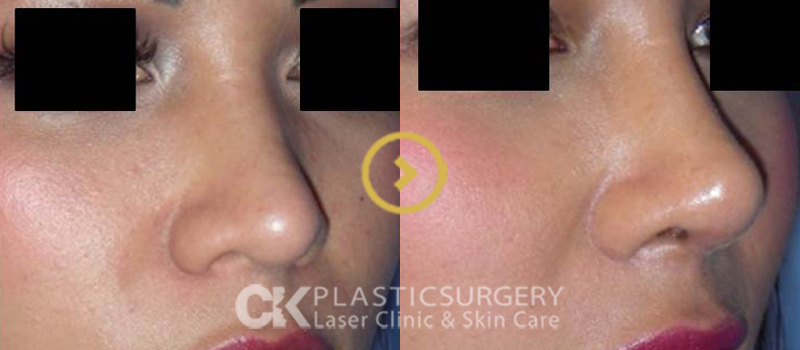 Nose Augmentation Orange County