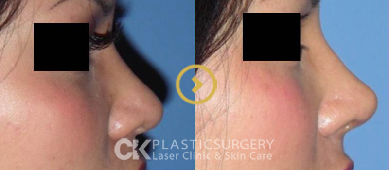 Asian Nose Augmentation Orange County