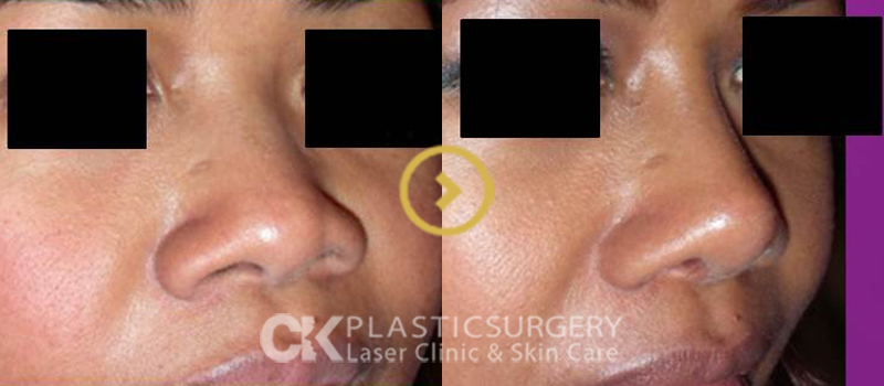 Rhinoplasty in LA