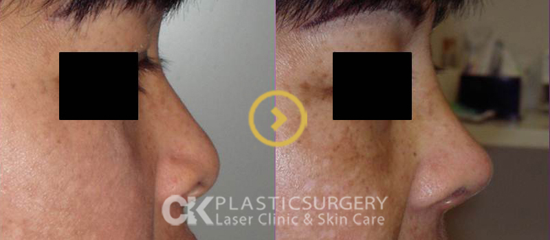 Rhinoplasty Surgery in Orange County