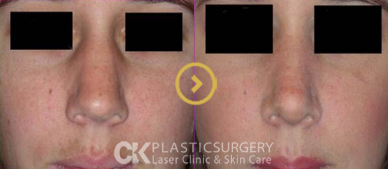 Asian Nose Augmentation 