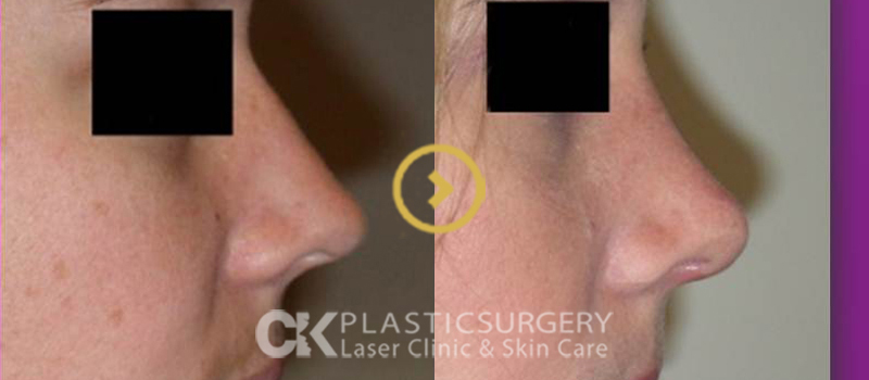 Before and After – Nose Surgery