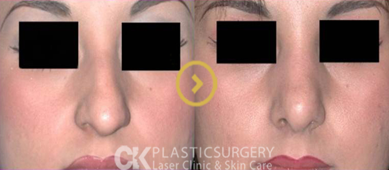 Nose Augmentation – Before and After