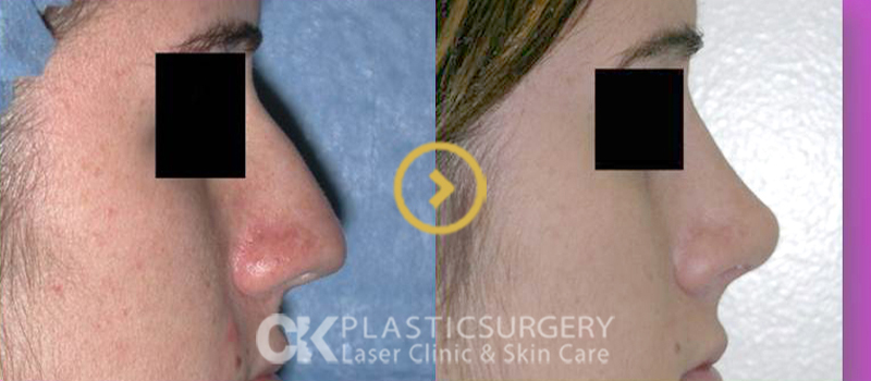 Nose Augmentation Orange County