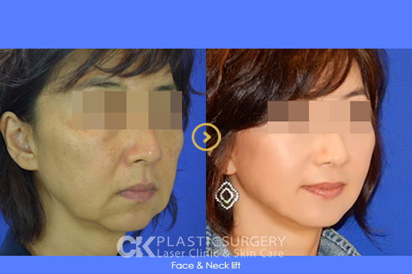 Best Facelift Orange County