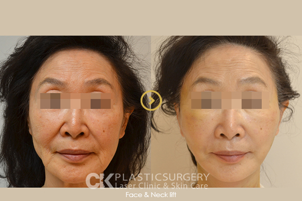 Face Lift Surgery in Orange County