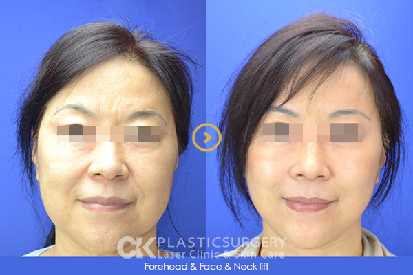 Best Facelift Orange County