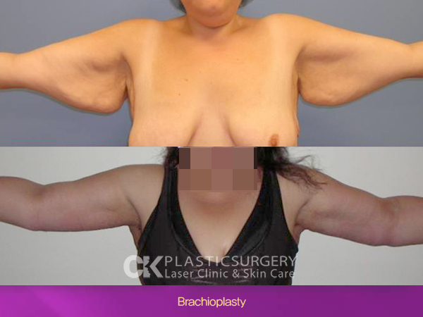 Brachioplasty in LA 