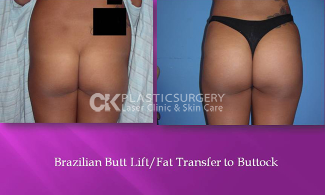 Butt Augmentation Los Angeles