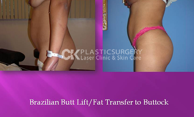 Buttock Augmentation Orange County