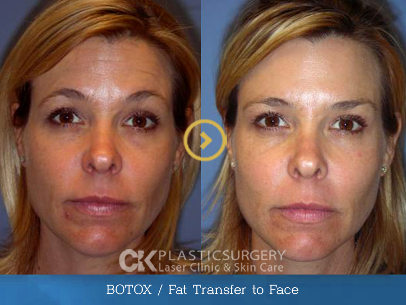 Botox – Non Surgical Facelift 