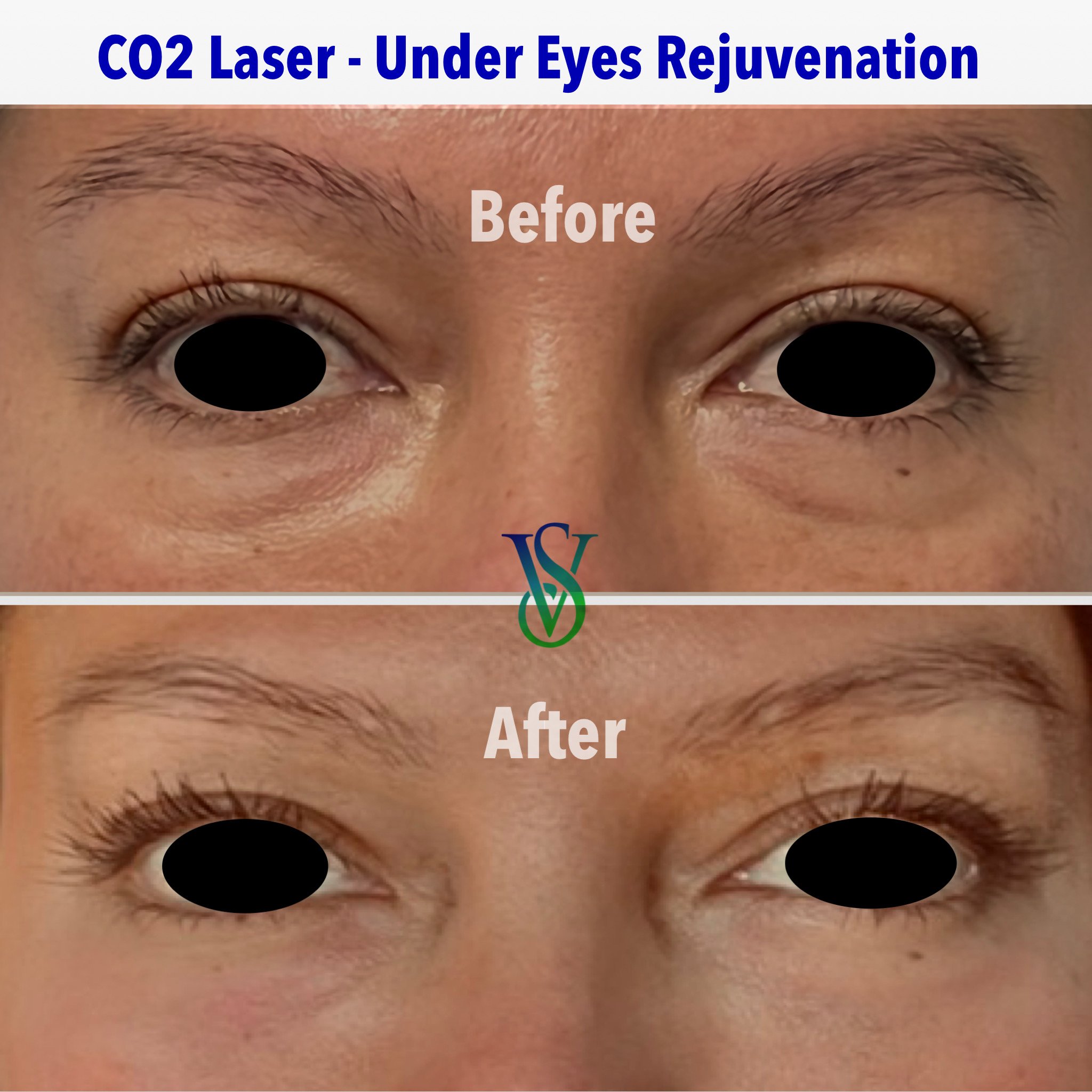 Best Eye Bag Treatment Near Me | AGNES RF for Wrinkles-Boston