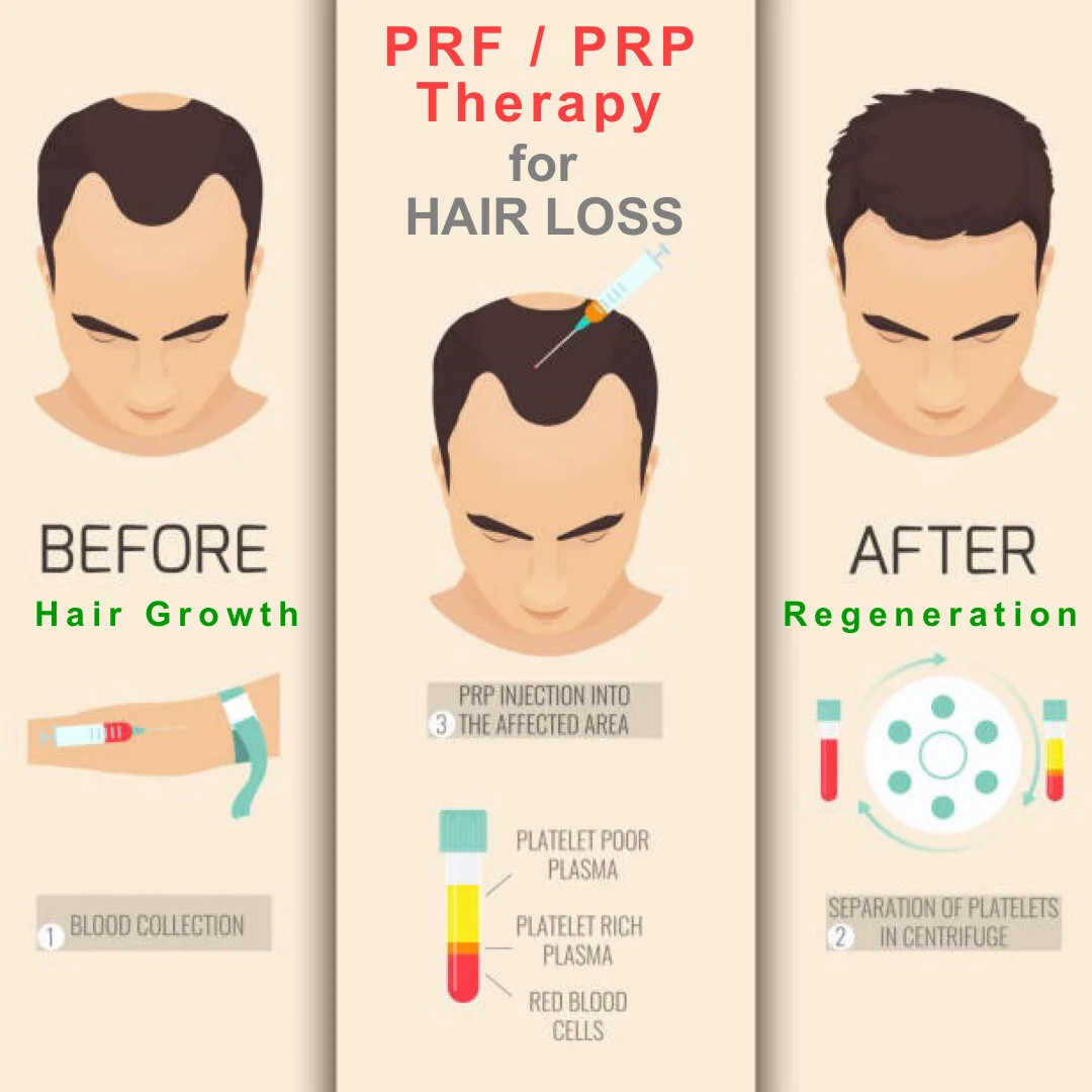 PRF / PRP therapy for hair loss