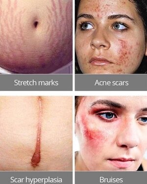 acne scars removal