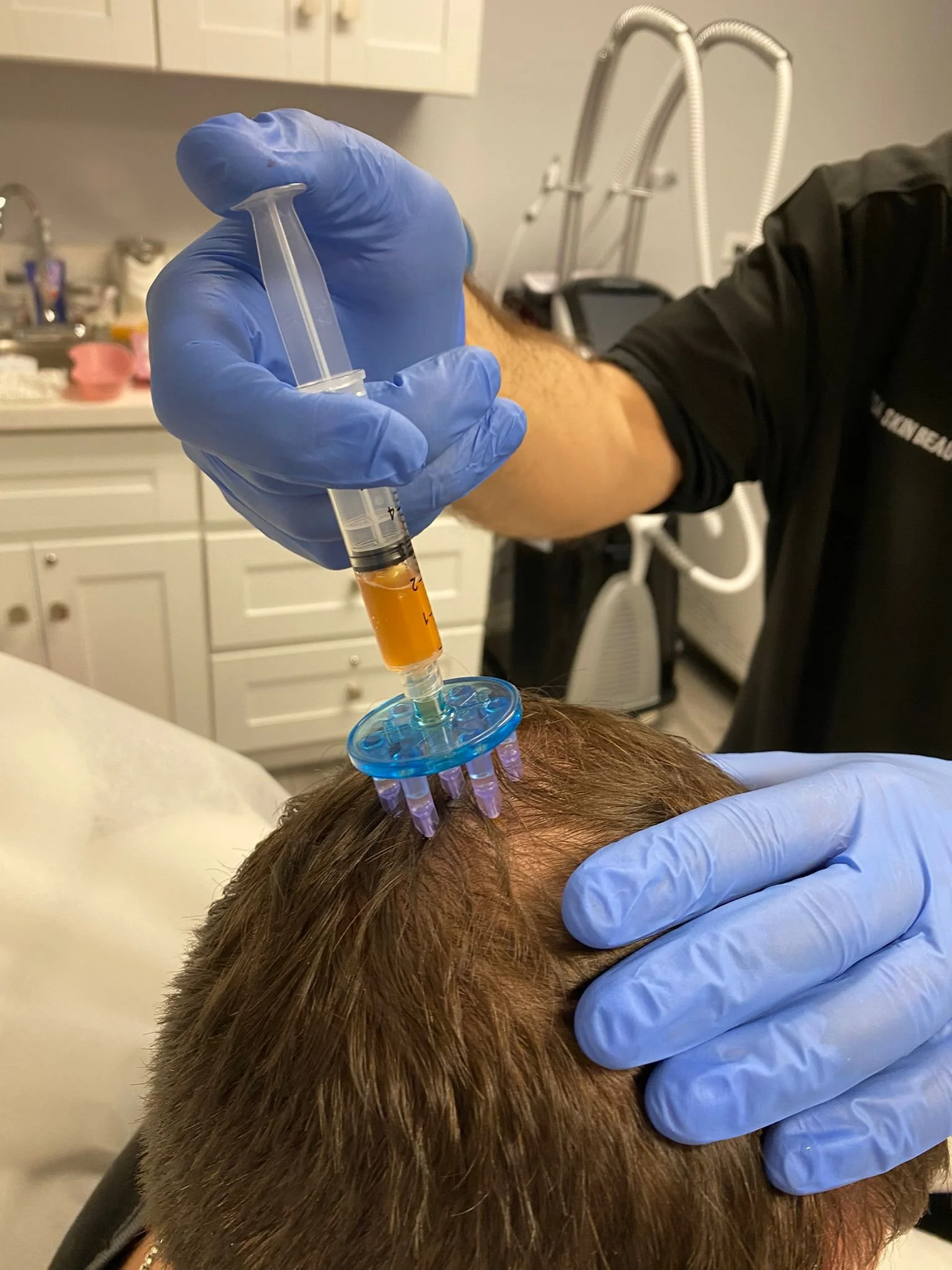 PRP HAIR REGENERATION