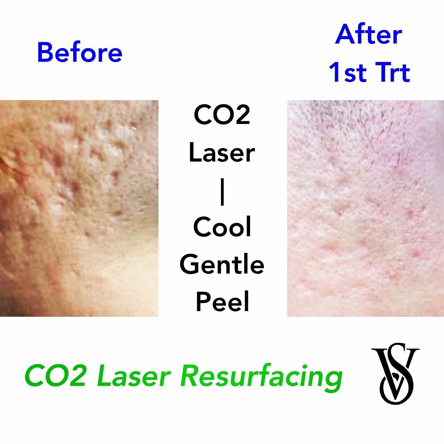 CO2 Laser &gt;  Cool-Gentle Peel &gt; Acne Scars Removal &amp; Skin Resurfacing.