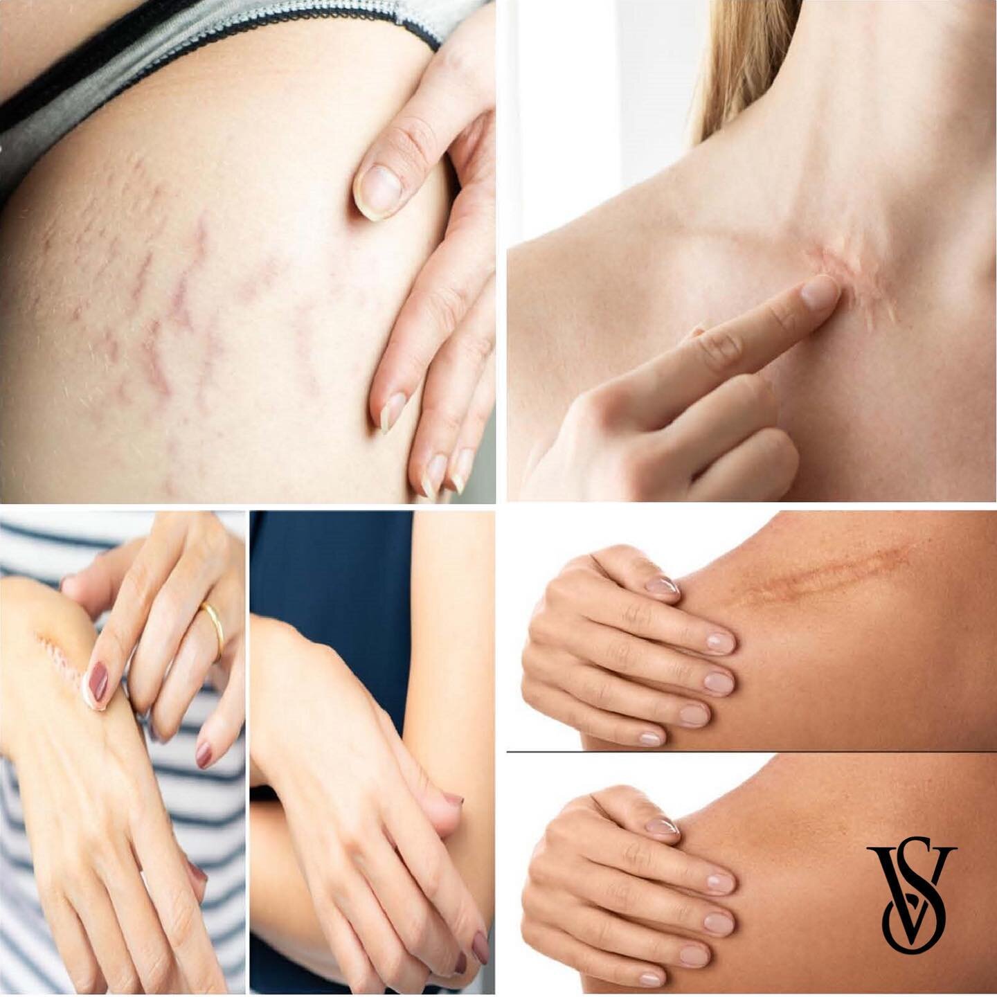 CO2 Laser - Scar Removal, Stretch Marks Removal (skin resurfacing)
👇
BIOK YOUR CONSULTATION!

#co2laser #skinresurfacing #skinrejuvenation #agelessbyabovian