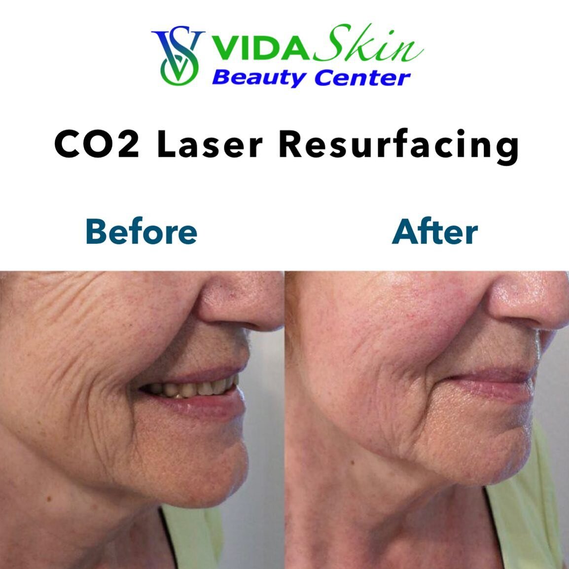 CO2 Laser Resurfacing and Rejuvenation!

👇
MULTIPLE BENEFITS:
&bull; Skin Tightening
&bull; Spot Removal
&bull; Wrinkle Removal
&bull; Collagen Creation
&bull; Pore Size Reduction
&bull; Learn more, link in bio.
👇
BOOK YOUR CONSULTATION!

#co2laser