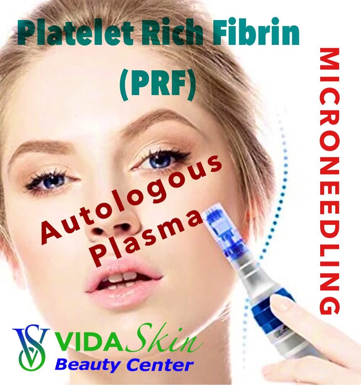 PRF Microneedling, with organic Autologous Plasma, knows as Platelet Rich Fibrin (PRF).
▫️
PRF (2nd generation PRP)
▫️
Skin Rejuvenation,
Collagen Production
Skin tightening,
Increases Glow,
Improves Acne,
Improves Wrinkles,
Reduces pores,
Reduces su