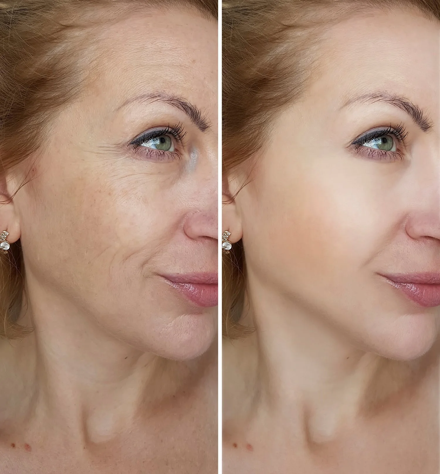 CO2 Laser Resurfacing