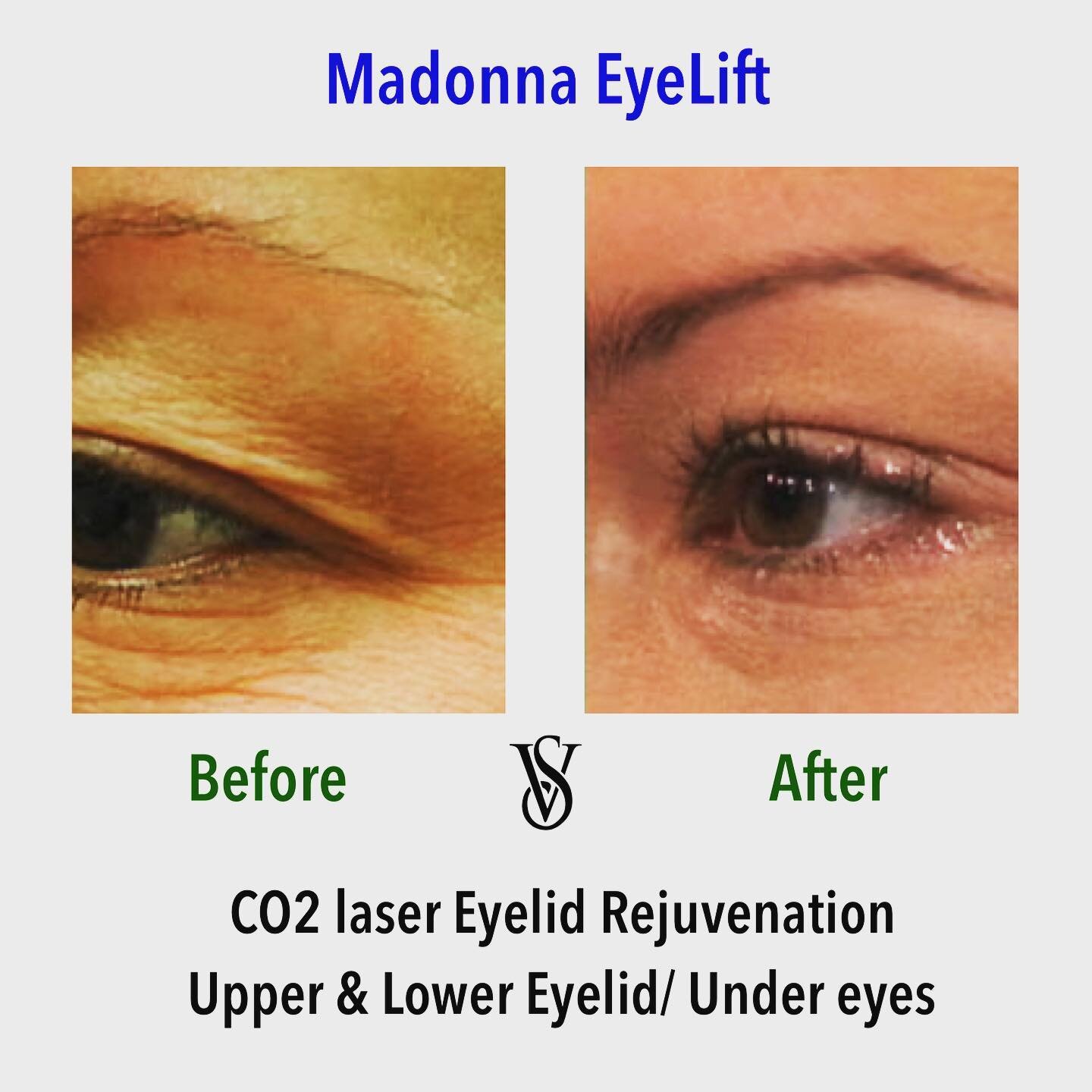 Madonna Eyelift, CO2 Laser Eyelid Lift &amp; Rejuvenation. Improving Upper &amp; Lower Eyelids, Decreasing wrinkles and eyelid crease, UnderEyes improvement.