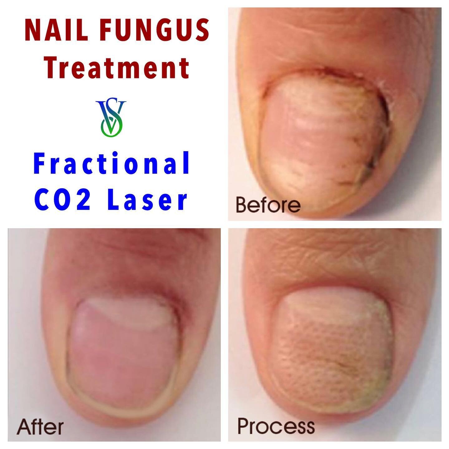 CO2 Laser - Nail Fungus Fractional Treatment. 
▫️
Combined CO2Fx Nail Fungus treatment with topical anti-fungals.
▫️
▫️

#skinrejuvenation, #skincare, #antiaging, #beauty, #skincareroutine, #skin, #botox, #glowingskin, #microneedling, #acne, #skintig