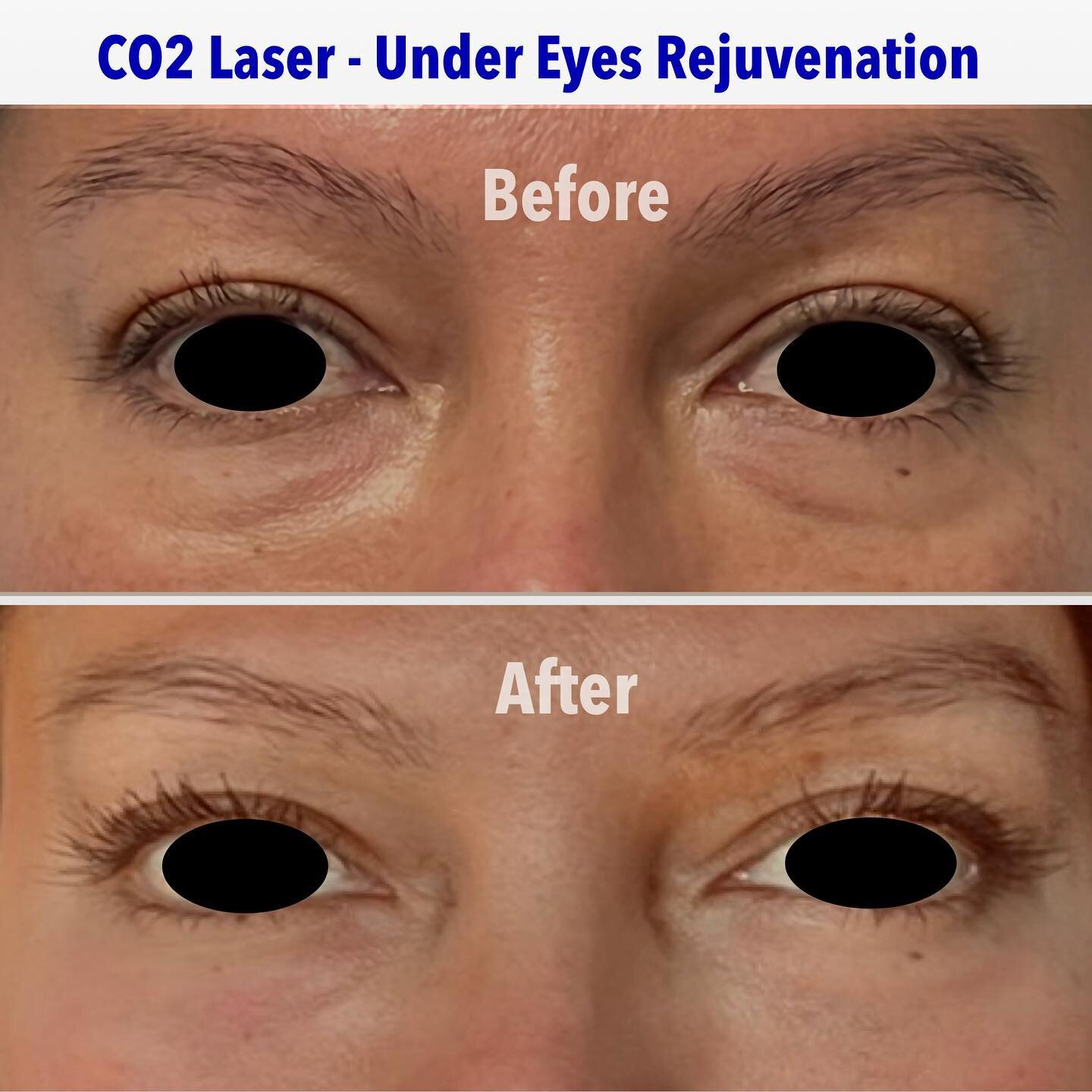 CO2 Laser Under Eyes Rejuvenation, Under Eyes Bags Reduction, Under Eyes Dark Circles Correction.
👇
BOOK NOW
▫️
#undereye #undereyebags #co2laserskinresurfacing #co2laserrejuvenation