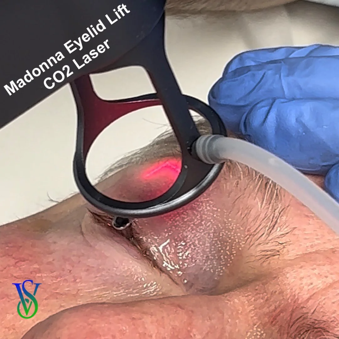 CO2 Laser Madonna Eyelid Lift