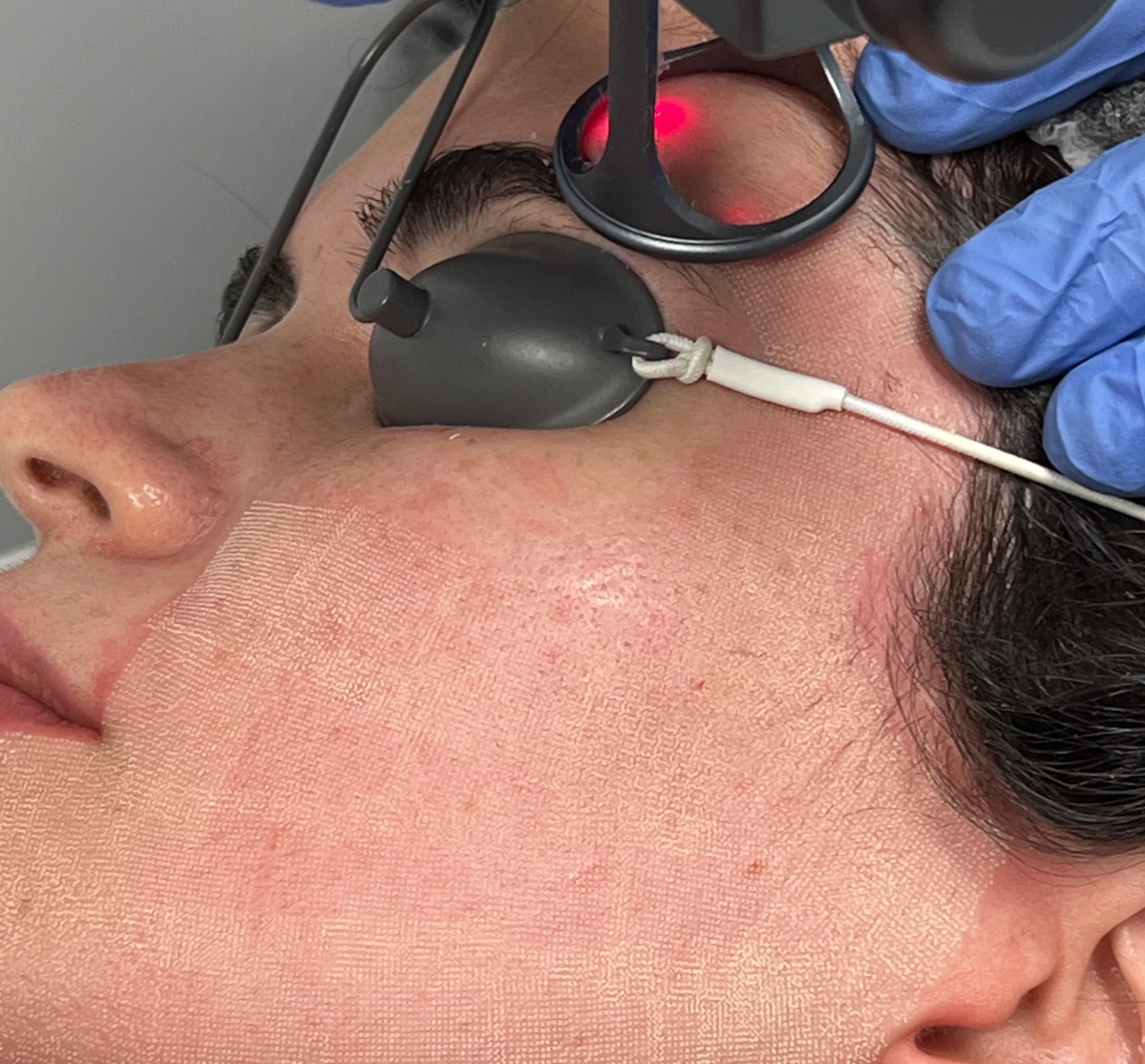 Gentle / Cool Peel CO2 Laser