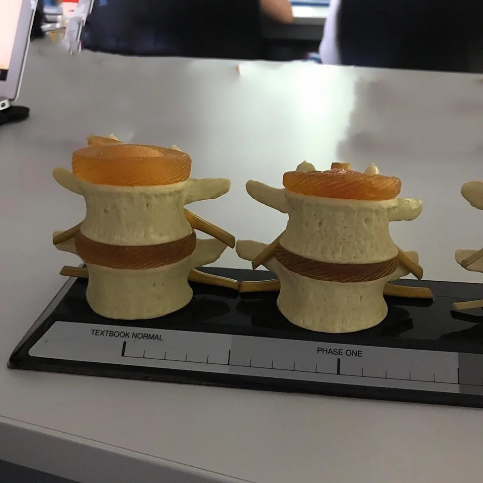 Shows a healthier spinal segment leading to signs of degenerative disc disease