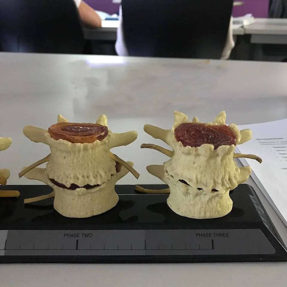 Degenerative disc disease, what a vertebral segment can start to look like
