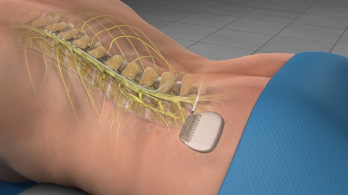 Spinal Cord Stimulator - Atlas Pain Management Clinic