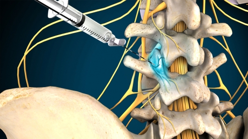 Spinal Cord Stimulator - Atlas Pain Management Clinic