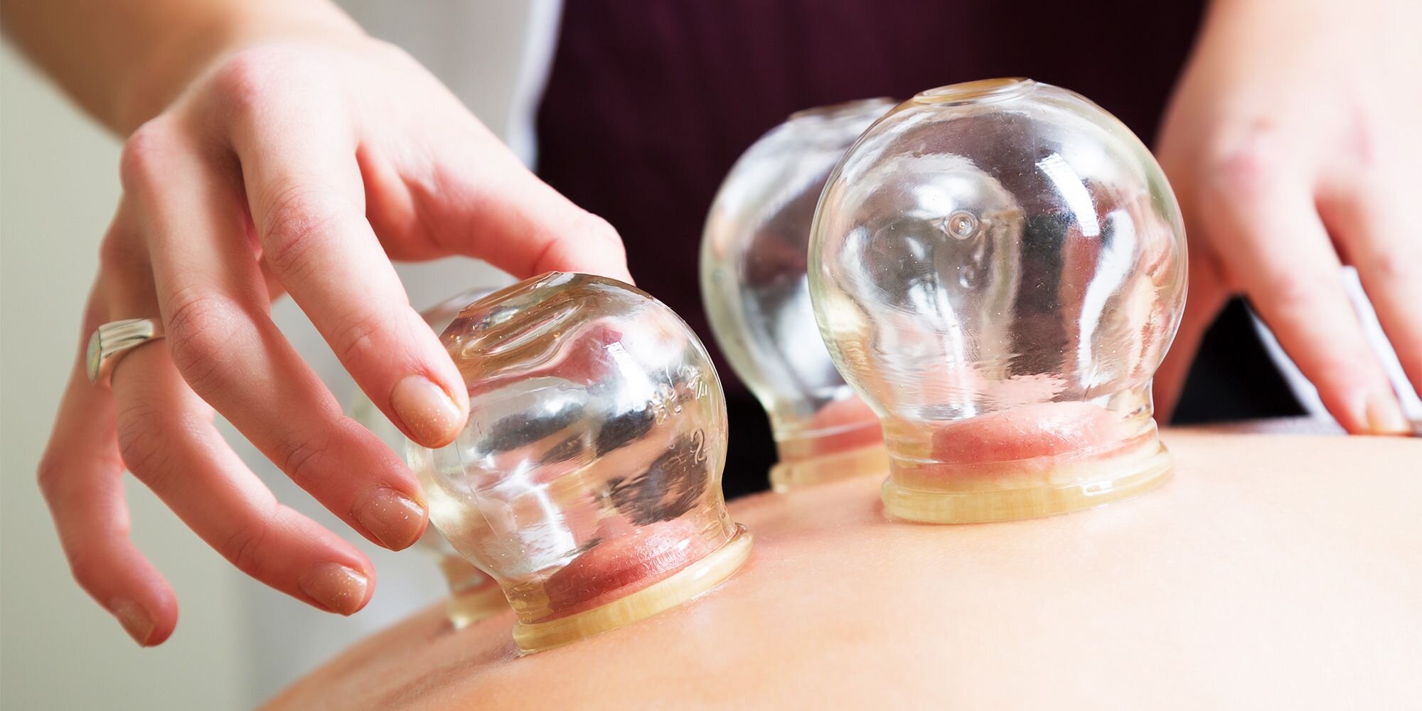 cupping-and-chronic-pain-1530049333.jpg
