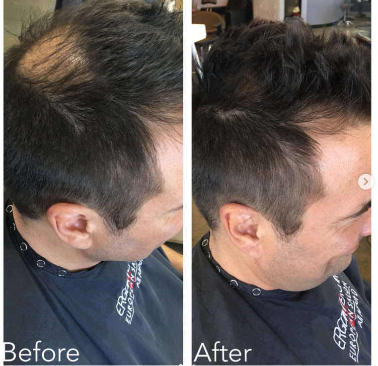 Defy the Receding Hairline and Get Hair Extensions — Ergun Tercan